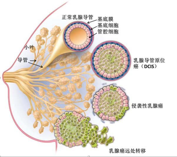 乳腺导管瘤 真人图片